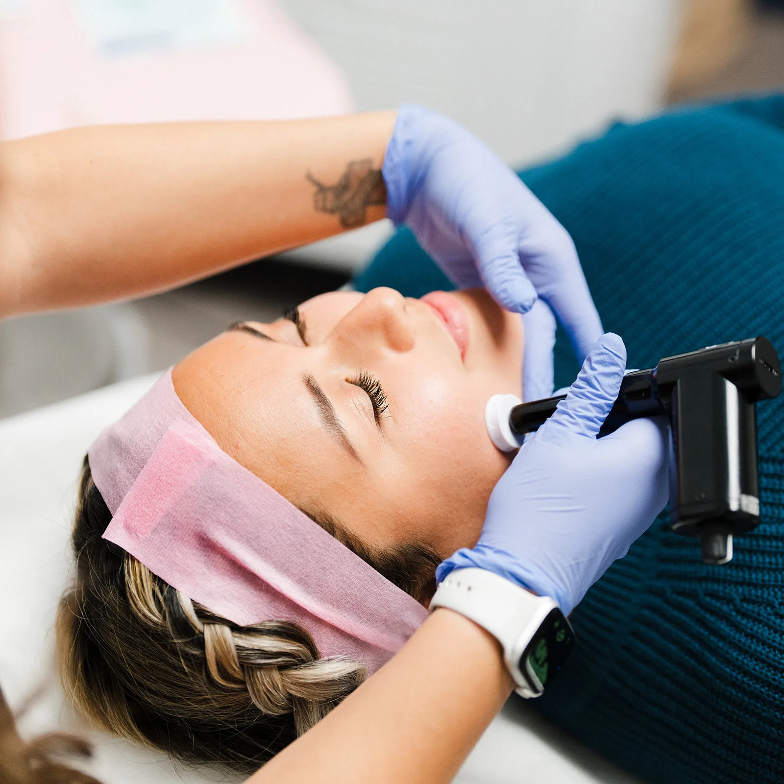 Microneedling skin treatment